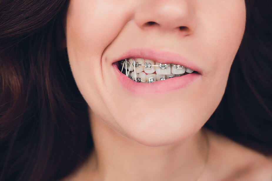 What happens if you wear the wrong size rubber bands on braces?