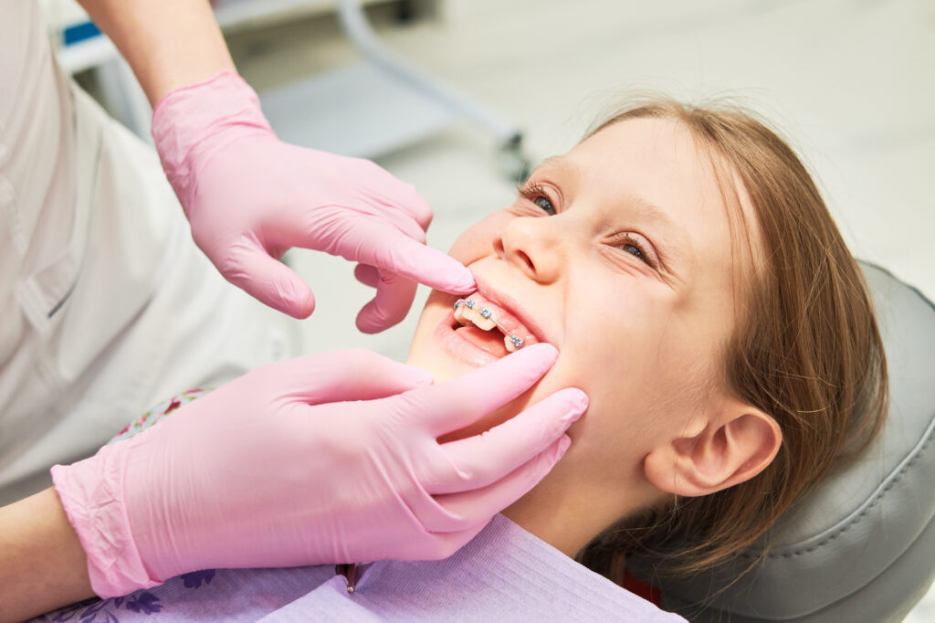 Braces for child teeth correction. Installation and maintenace
